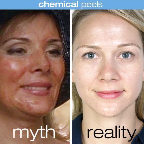 Anti Aging Acne Peels