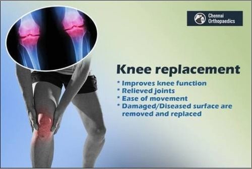 Total Knee Replacement Treatment Services