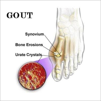 Gouty Arthritis Treatment