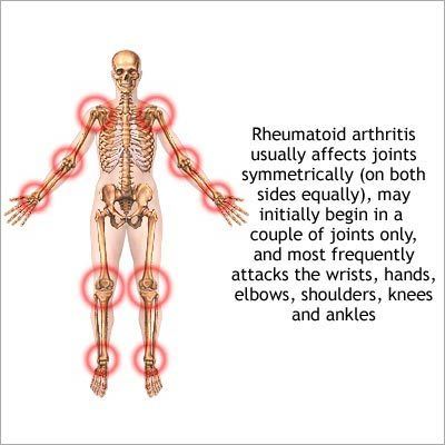 Arthritis Homeopathic Treatment