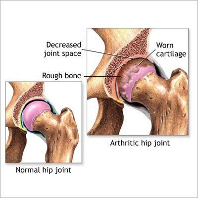 Joint Pain Homeopathic Treatment