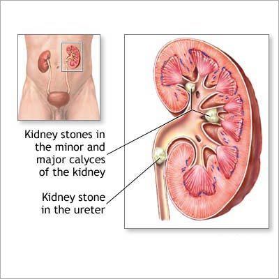 Kidney Disease Homeopathic Treatment