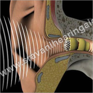 What is Hearing loss?