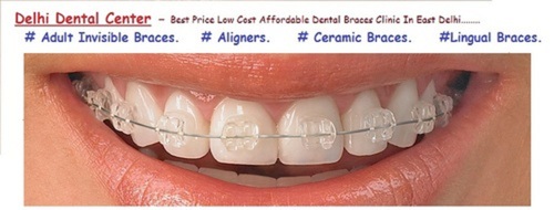 Dental Braces Treatment Services By DELHI DENTAL CENTER