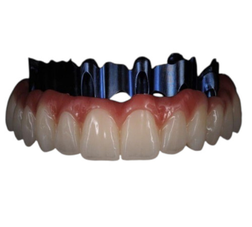 Full Arch Implant Supported Dental Bridge
