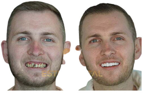 Dental Zirconium Crown