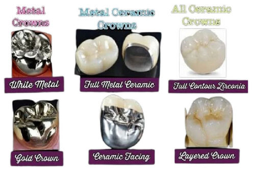 Dental Ceramic Crown