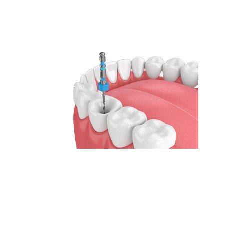 Root Canal Dental Treatment Service By VIVO DENTAL
