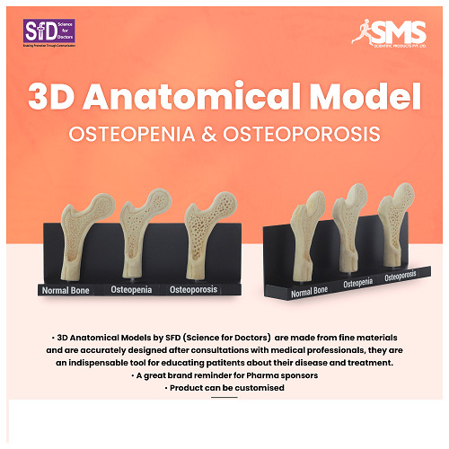 3D Anatomical Model - Osteoporosis