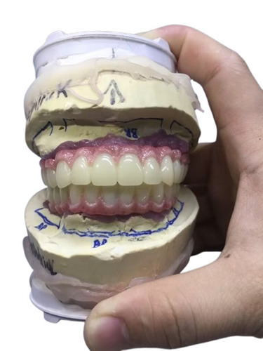dental bridge