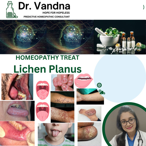 Online Lichen Planus Skin Homeopathy Treatment