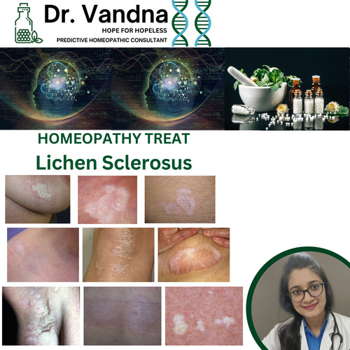 Online Lichen Sclerosus Skin Homeopathy Treatment