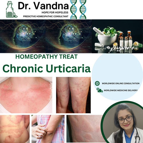 Online Skin Chronic Urticaria Homeopathy Treatment