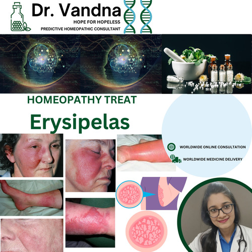Online Skin Erysipelas Homeopathy Treatment