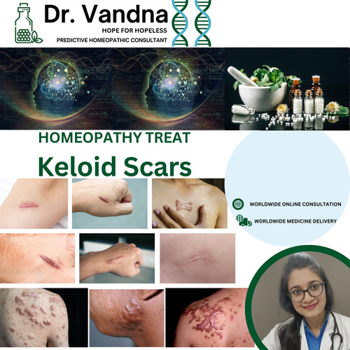 Online Skin Homeopathy Treatment Keloid Scars 