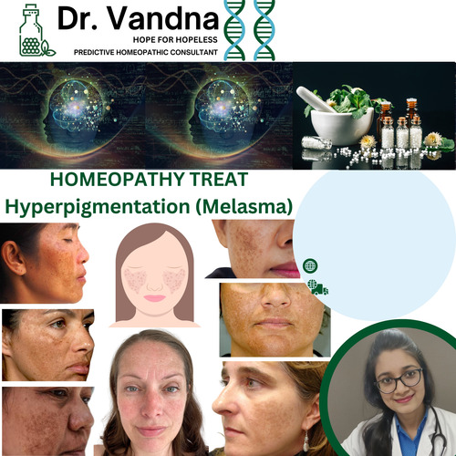 Online Skin Hyperpigmentation Homeopathy Treatment
