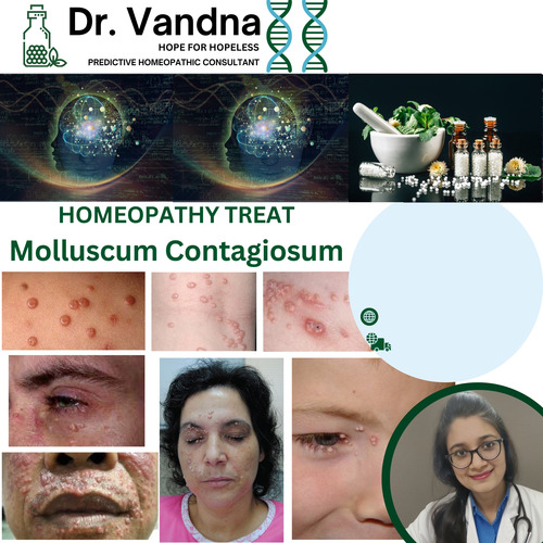Online Skin Molluscum Contagiosum Homeopathy Treatment