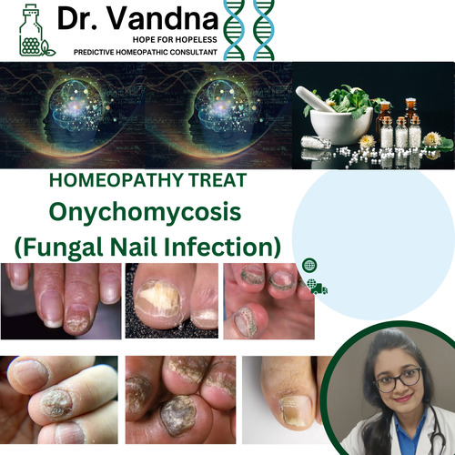 Online Skin Onychomycosis Homeopathy Treatment