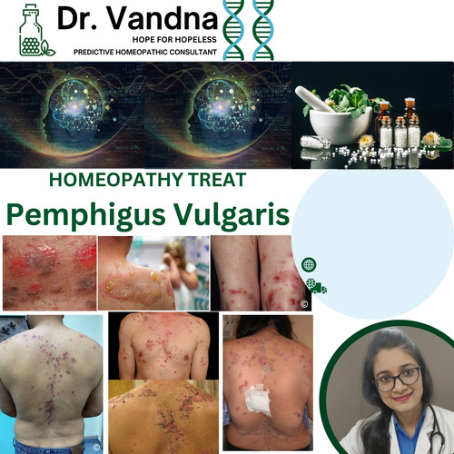 Online Skin Pemphigus Vulgaris Homeopathy Treatment