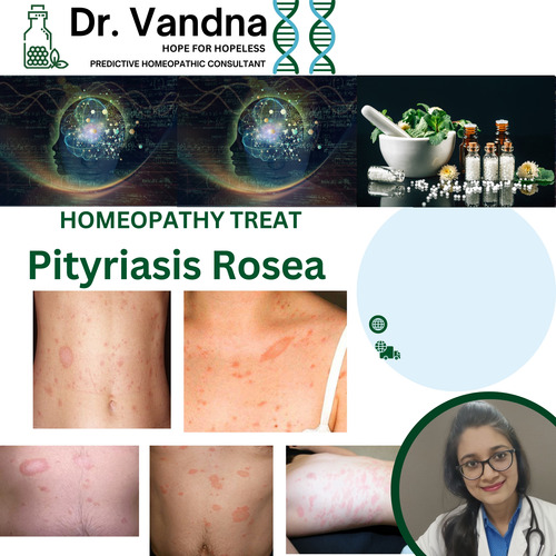 Online Skin Pityriasis Rosea Homeopathy Treatment