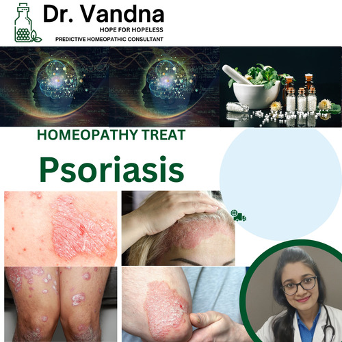 Online Skin Psoriasis Homeopathy Treatment