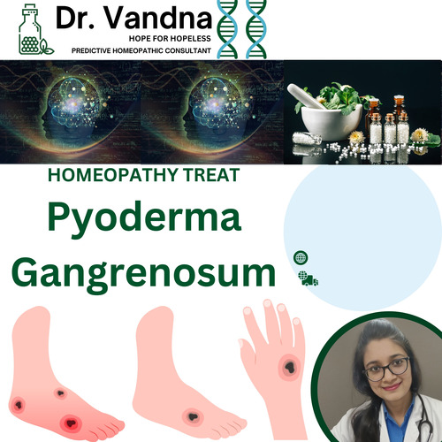 Online Skin Pyoderma Gangrenosum Homeopathy Treatment
