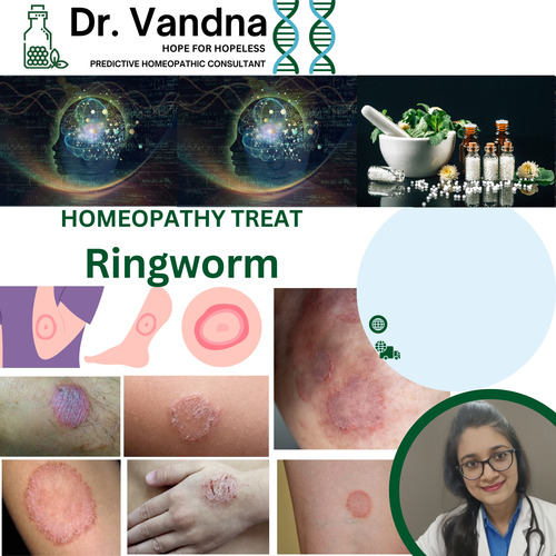 Online Skin Ringworm Homeopathy Treatment