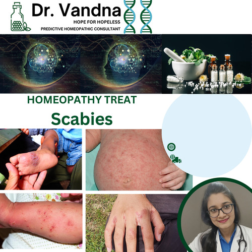 Online Skin Scabies Homeopathy Treatment