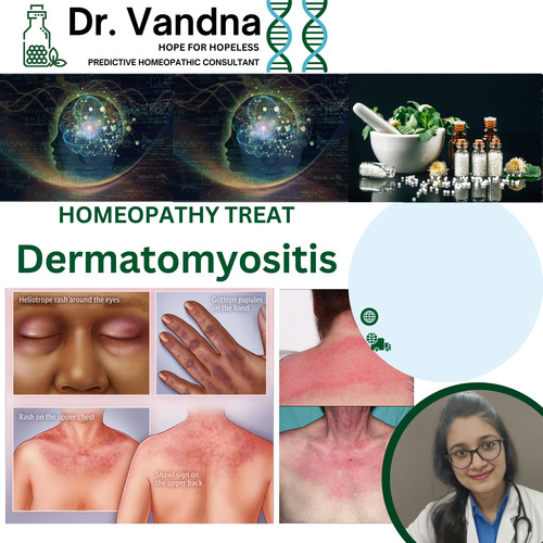 Online Skin Dermatomyositis Homeopathy Treatment