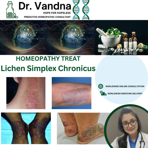 Online Skin Lichen Simplex Chronicus Homeopathy Treatment