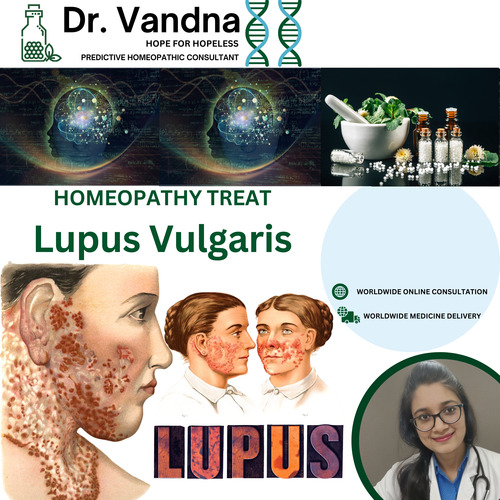 Online Skin Lupus Vulgaris Homeopathy Treatment