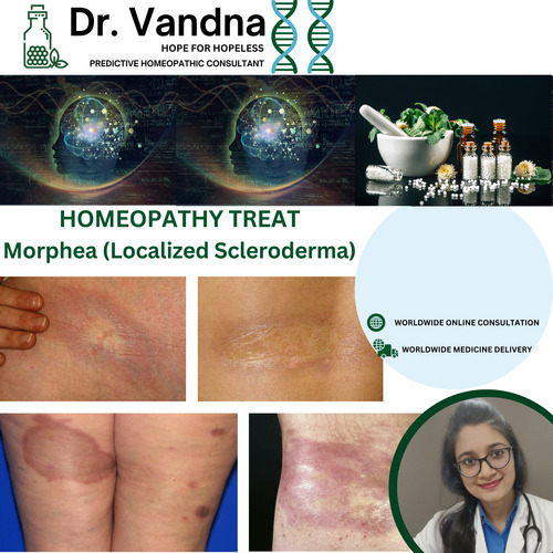 Online Skin Morphea Homeopathy Treatment