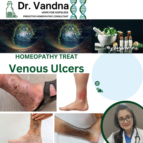 Online Skin Venous Ulcers Homeopathy Treatment