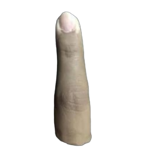 Index Finger Prosthesis
