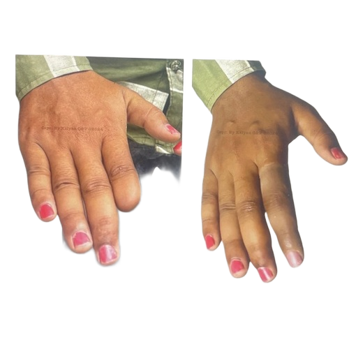Silicone Finger Prosthesis - Color: Natural