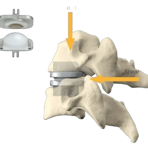 Orthopedic Total Disc Replacement Implants