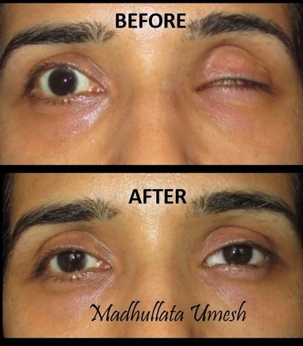 Custom Made Artificial Eye at Best Price in Mira Bhayandar