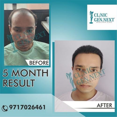 Hair Transplant Services