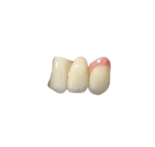 Dental Bridge Prosthesis