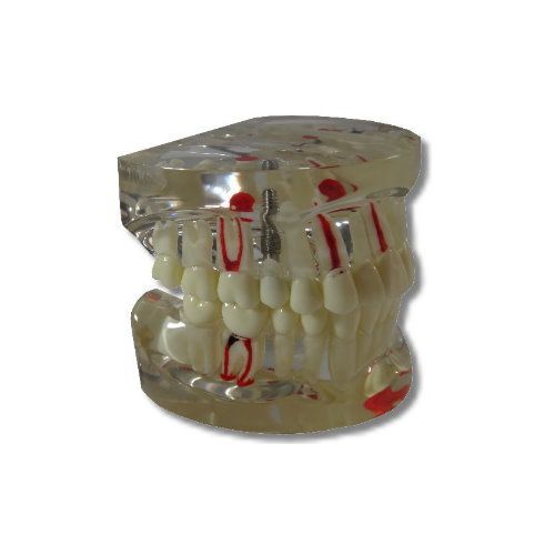 Dental Model Dim-01 Transparent Implant & Diseases Model Hann Ru