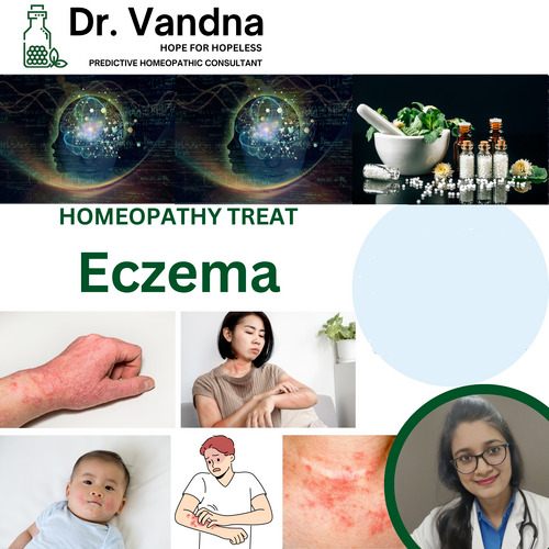 Skin Homeopathy For Eczema