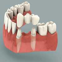 Dental Bridge