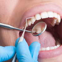 Dental Fillings